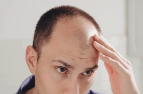 uomo con calvizie precoce